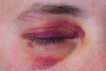 health black eye